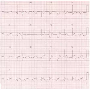 STEMI equiv 5 Posterior-MI